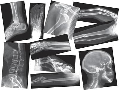 Roylco® Broken Bones X-Rays