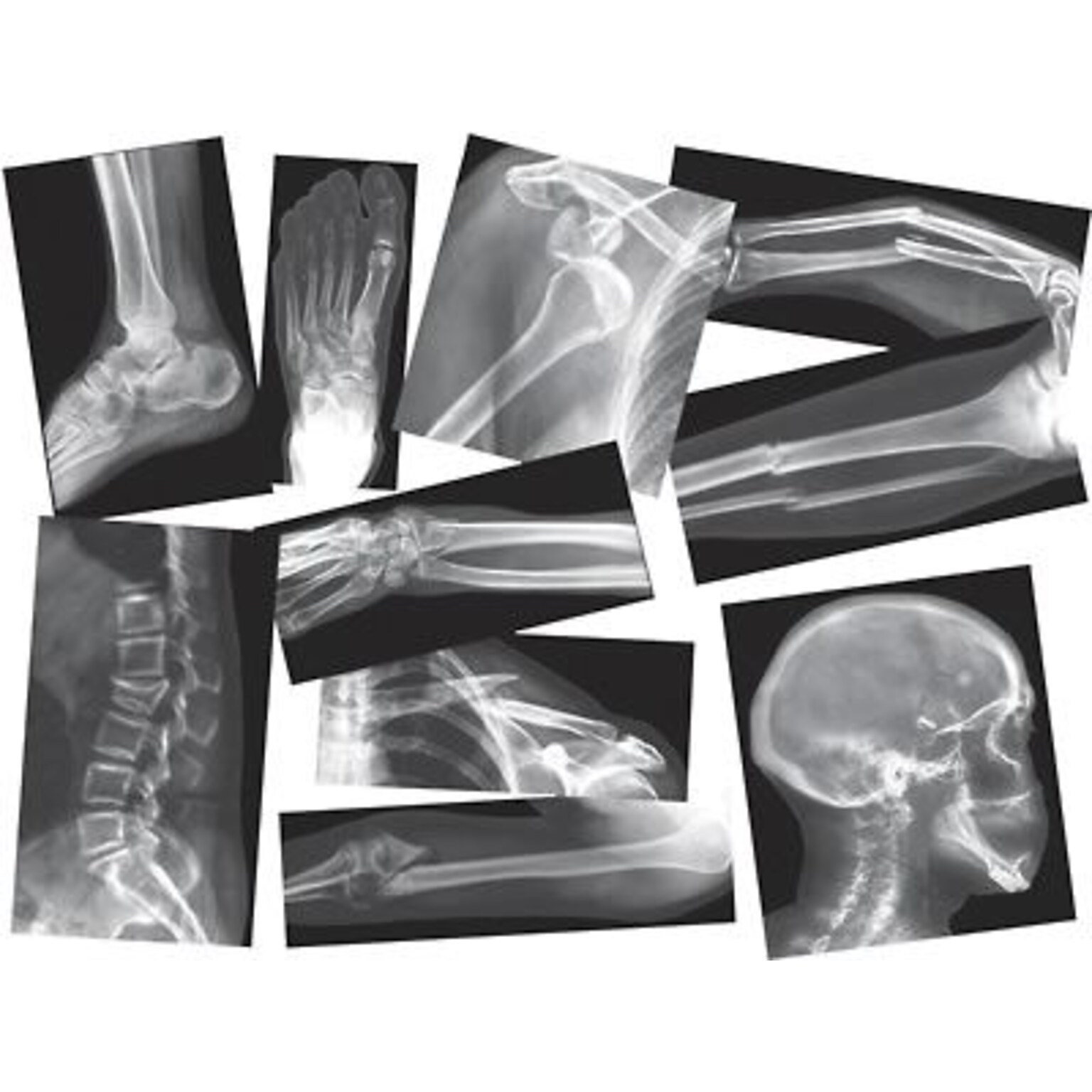 Roylco® Broken Bones X-Rays