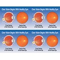 Preventive Postcards; for Laser Printer; Eye Cross Section/ Interior, 100/Pk