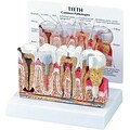 Diseased Teeth and Gums Dental Models