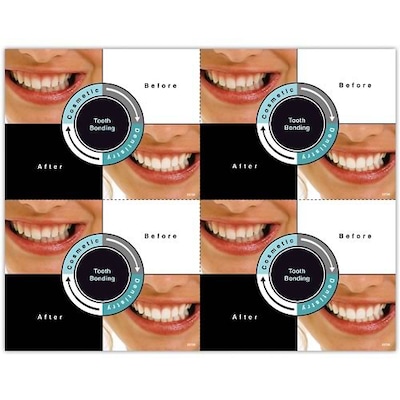Photo Image Laser Postcards; Before & After, Tooth Bonding, 100/Pk
