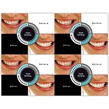 Photo Image Laser Postcards; Before & After, Tooth Bonding, 100/Pk