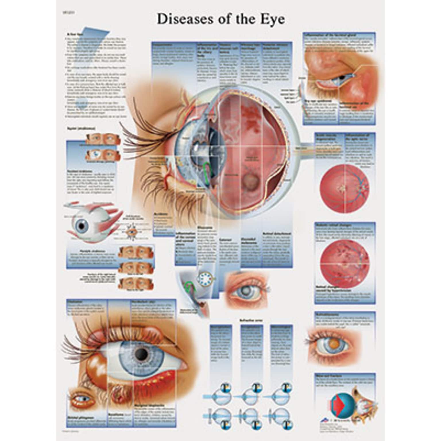 3B Scientific® Anatomical Charts; Diseases of the Eye, Laminated